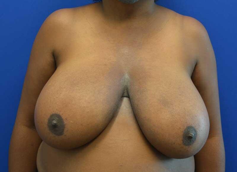 Breast Reduction Before & After Image