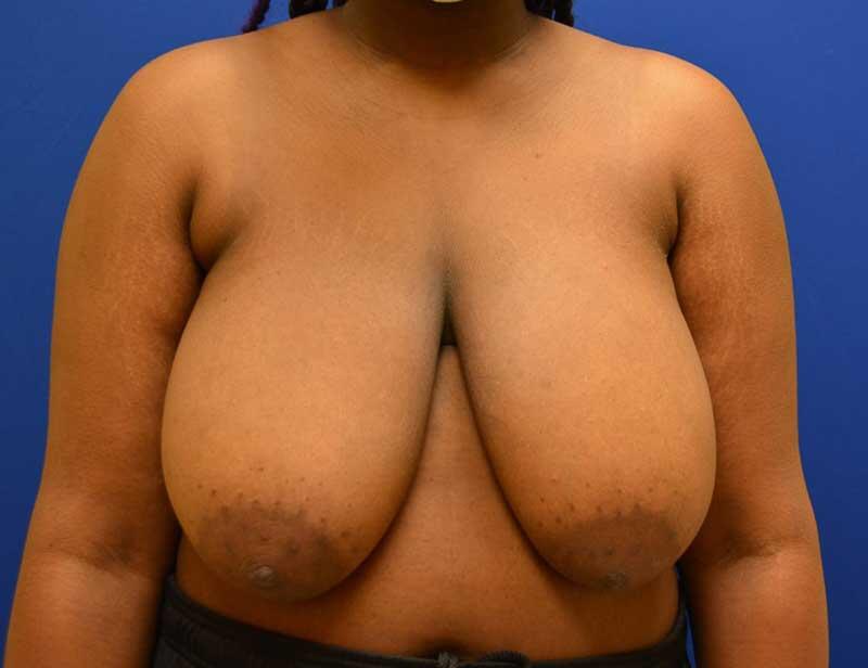 Breast Reduction Before & After Image