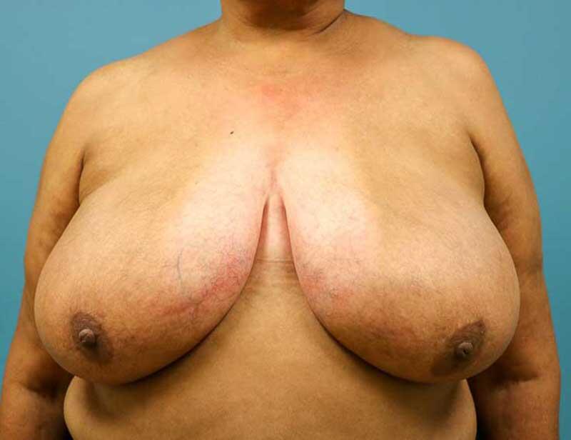 Breast Reduction Before & After Image