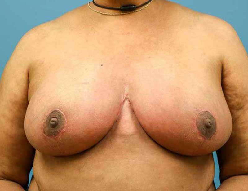 Breast Reduction Before & After Image