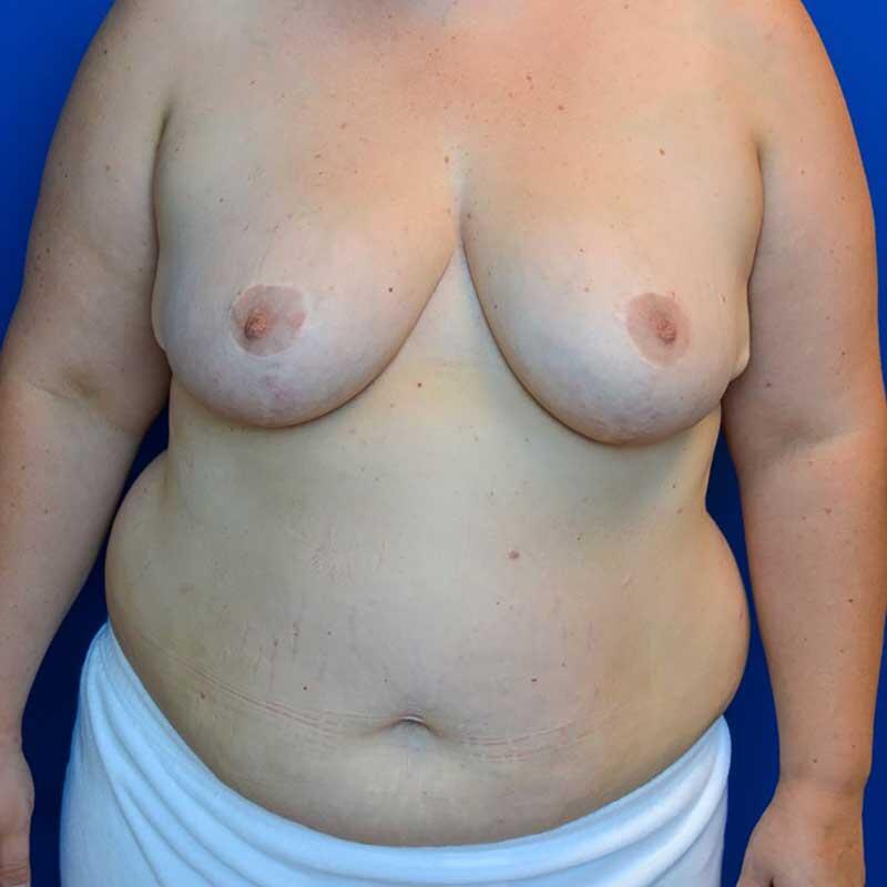 Breast Reconstruction (DIEP flap) Before & After Image