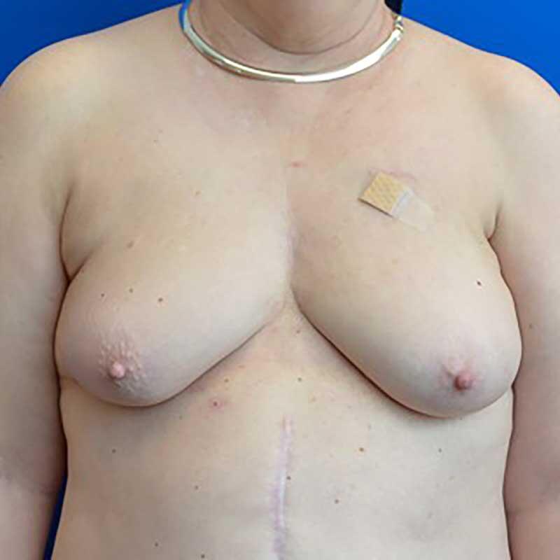 Breast Reconstruction (DIEP flap) Before & After Image