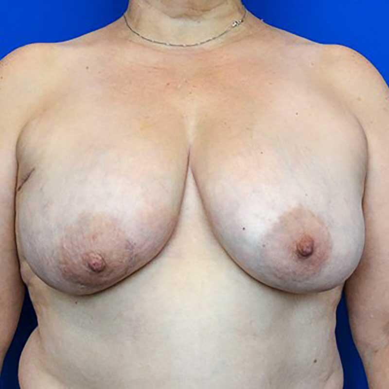 Breast Reconstruction (DIEP flap) Before & After Image