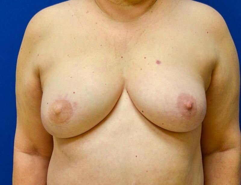 Breast Reconstruction (DIEP Flap) Before & After Image