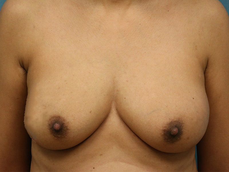 Breast Reconstruction (DIEP Flap) Before & After Image