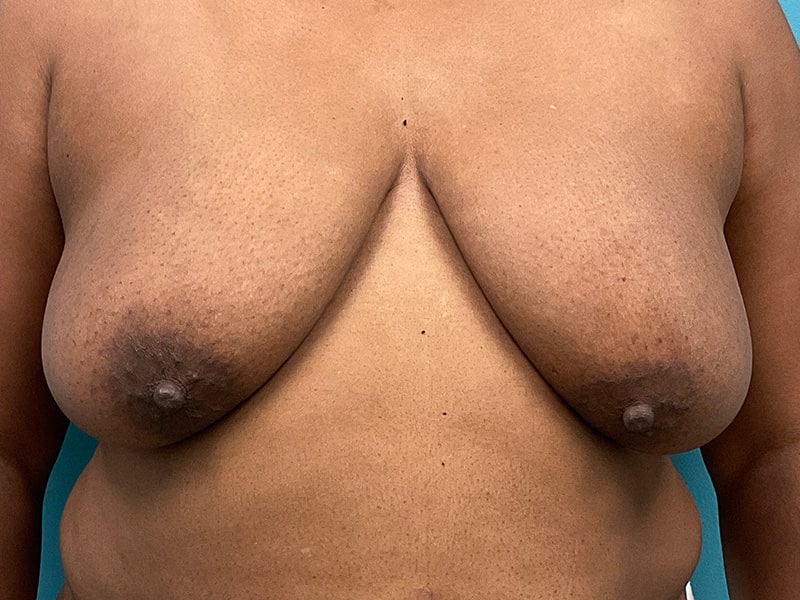 Breast Reconstruction (DIEP Flap) Before & After Image
