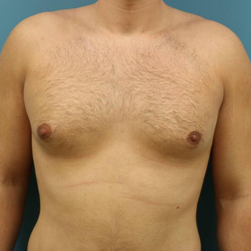 Gynecomastia Surgery Before & After Image