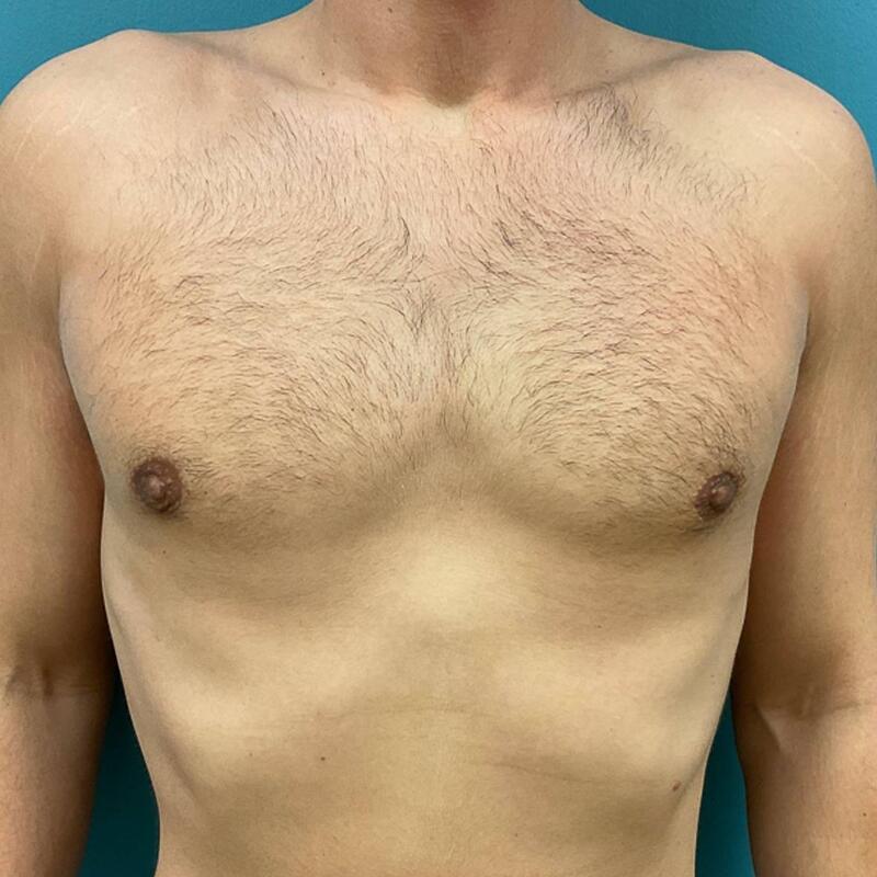 Gynecomastia Surgery Before & After Image