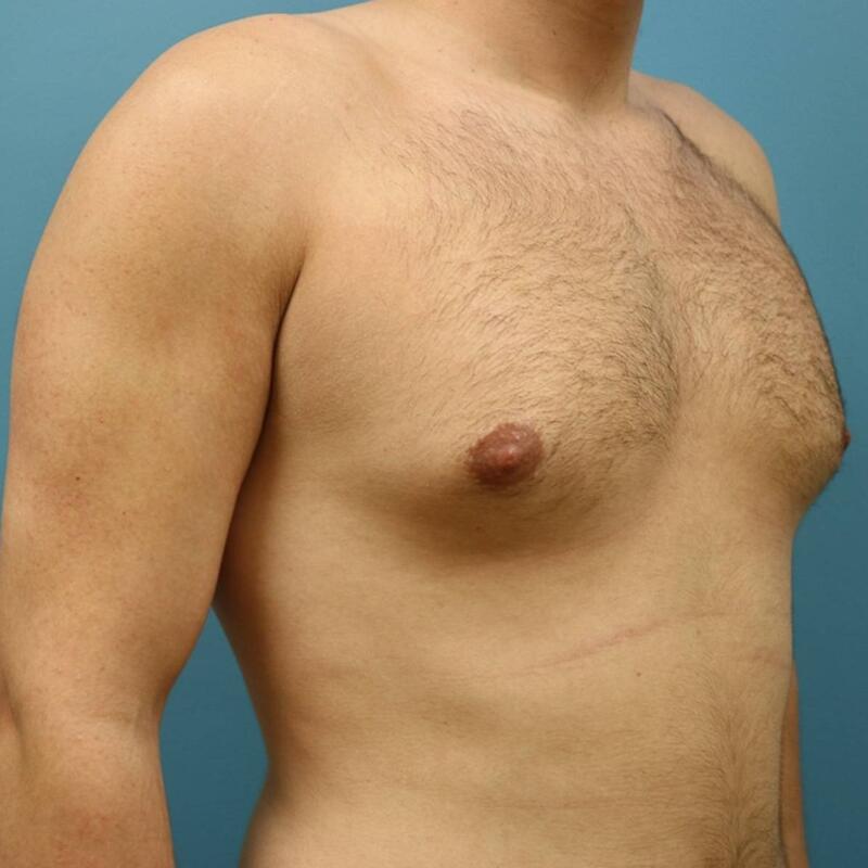 Gynecomastia Surgery Before & After Image