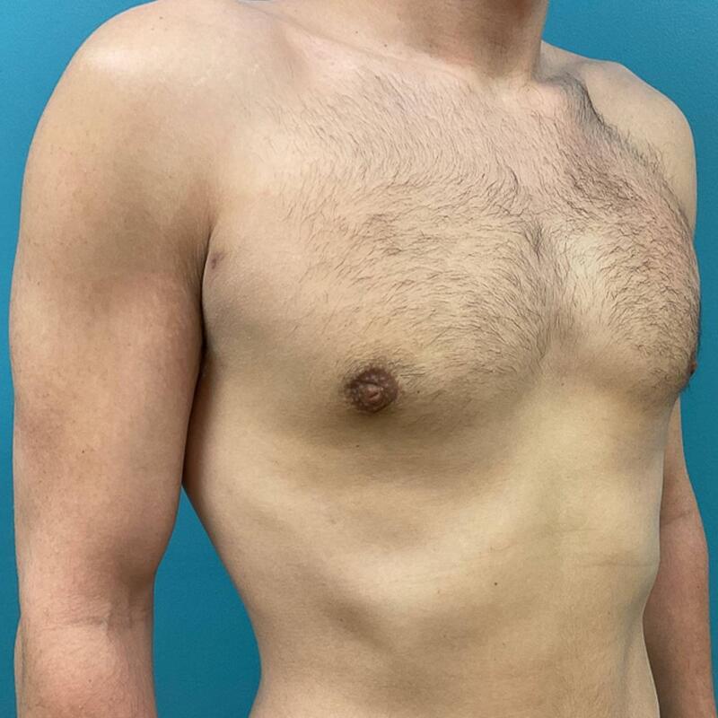 Gynecomastia Surgery Before & After Image