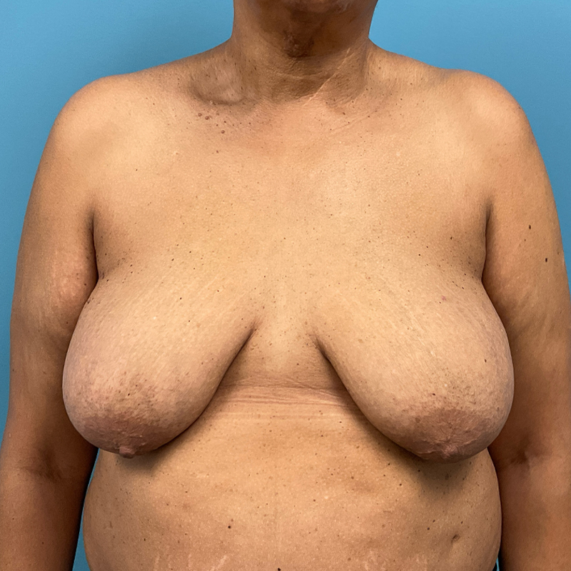 Breast Reconstruction (Implant Reconstruction) Before & After Image