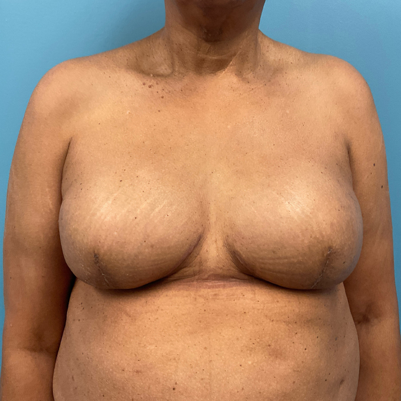 Breast Reconstruction (Implant Reconstruction) Before & After Image