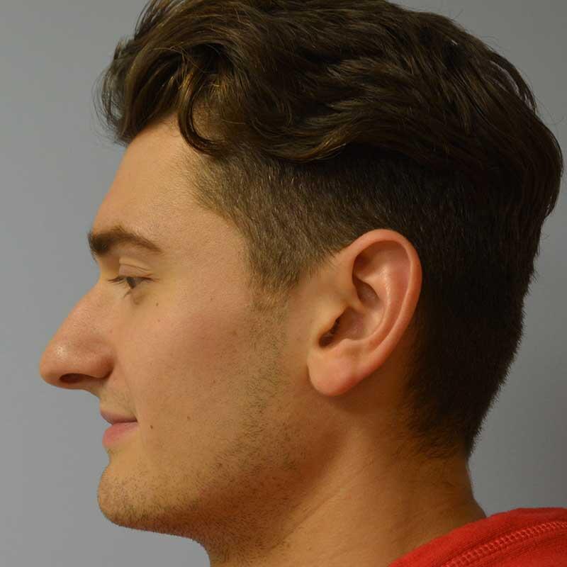 Rhinoplasty Before & After Image